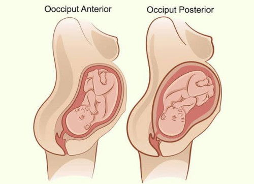 letak janin posterior
