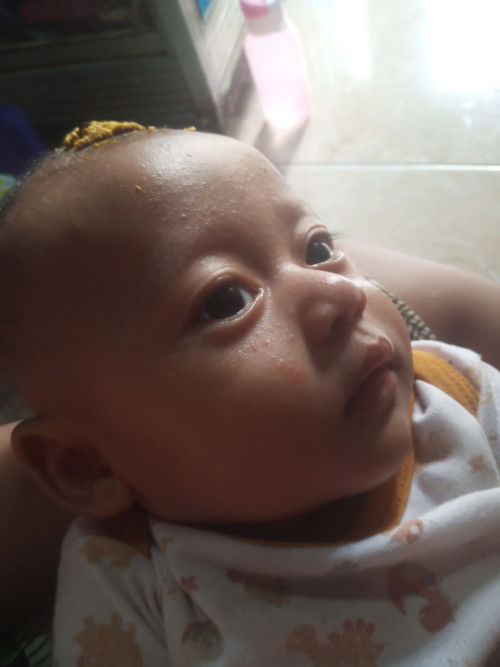Bruntusan/ biang keringat