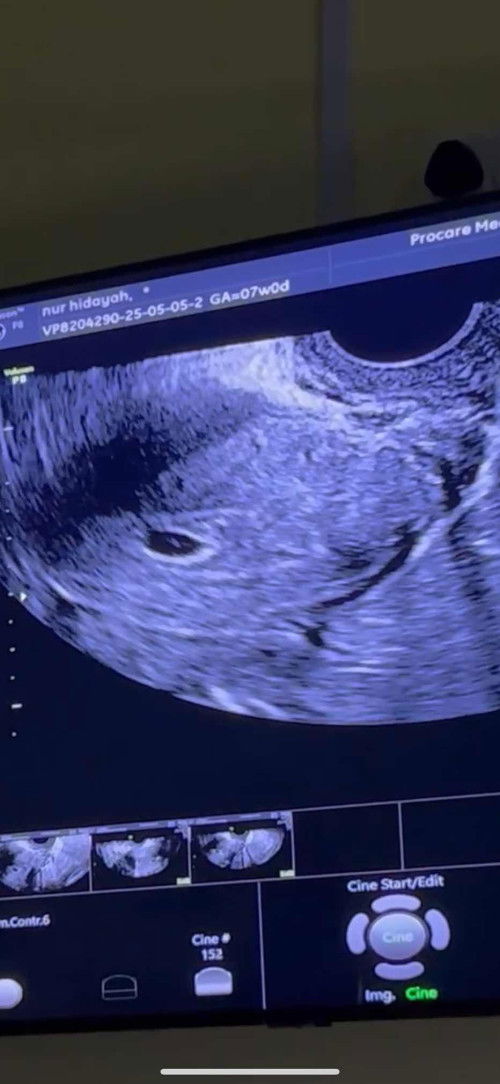 MY ULTRASOUNDS