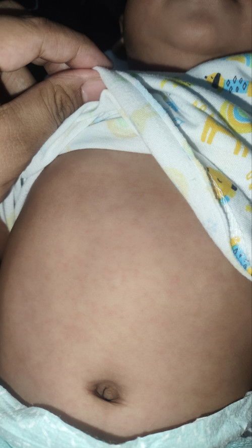 Remedy for Rashes