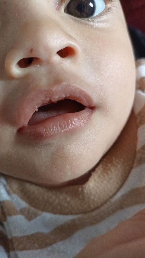 bibir anak pecah2