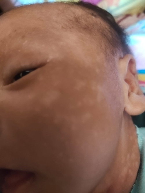Bercak putih
