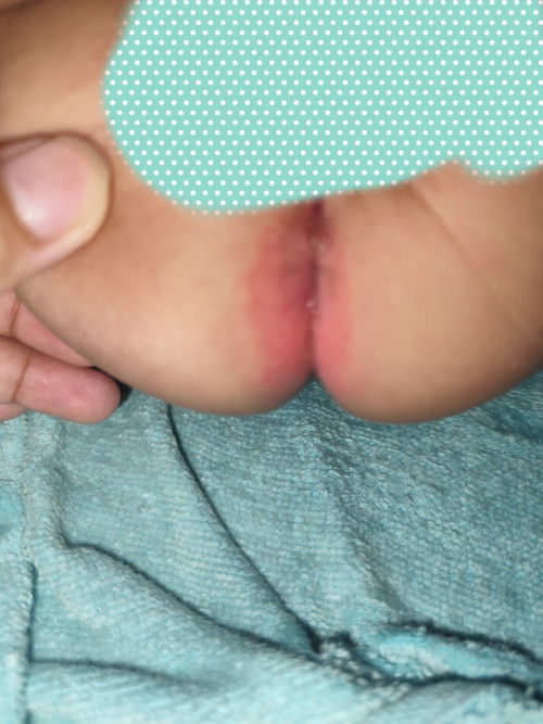 Merah di pantat