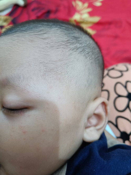 Bayi bentol kecil2 di kaki tangan dan muka aja