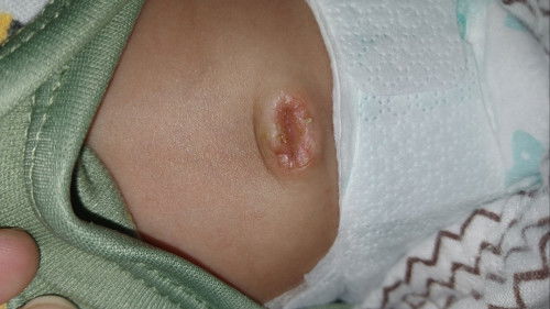 Puser bayi basah keluar cairan