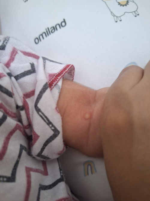 Bentol isi air pada bayi 1 bulan