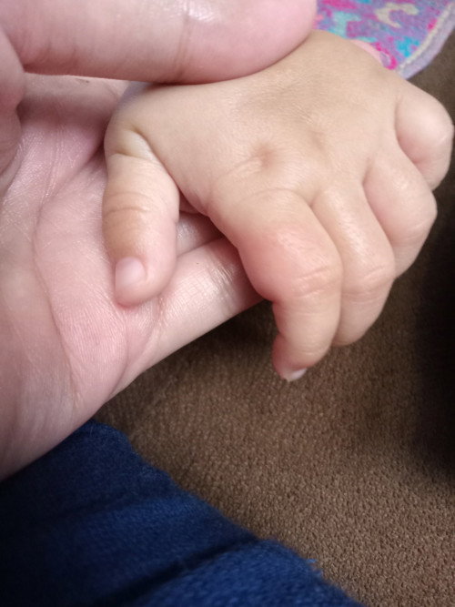 Mengatasi bengkak pada jari atau tubuh bayi.