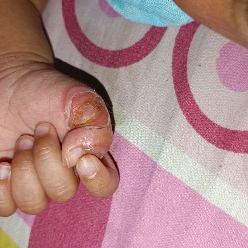 Luka melepuh pada bayi