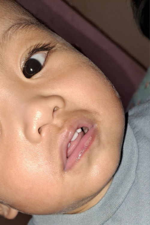 Bibir seperti melepuh