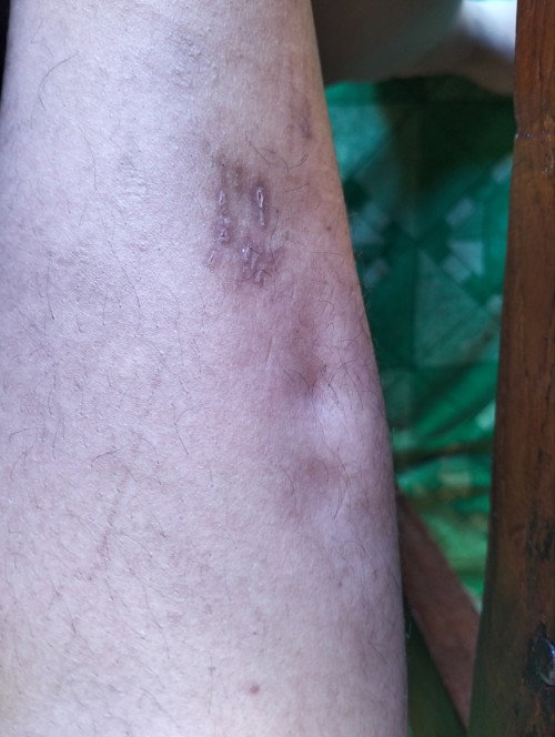 กดขาแล้วบุ๋ม ท้อง 36W