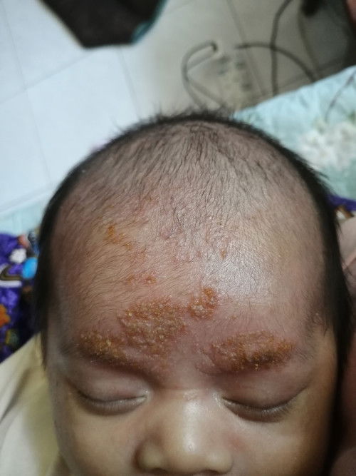 Hy MOMS.. pernah tk alami situasi mcm dlm gmbr? Baby umur 27 hari.. Apa benda tu dan mcmna nk rawat?