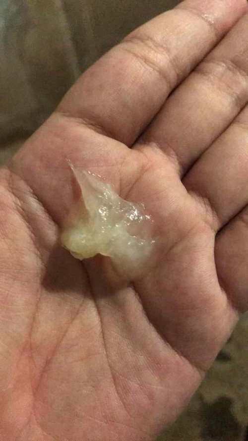 38+3 มีมูกใสแบบนี้ออกมา2วันแล้วค่ะมีเจ็บท้องนานๆทีเจ็บค่ะใกล้ยังคะหรือควรไปหาหมอดีคะ#ขอสอบถามแม่หน่อยค่ะ