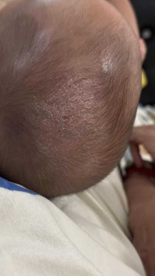 Kerak kepala bayi 4,5 bulan