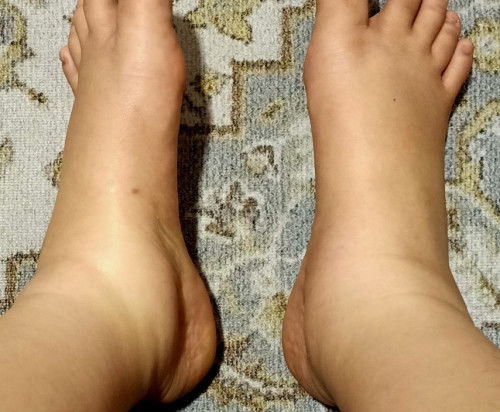 Kaki bengkak at 15 weeks