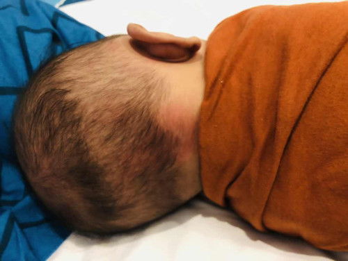 Merah belakang kepala bayi