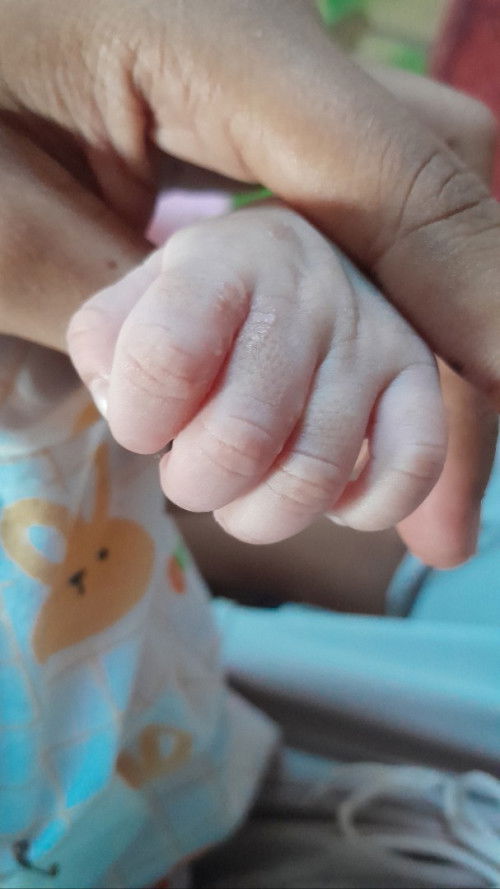 มีตุ่มใสบนมือ