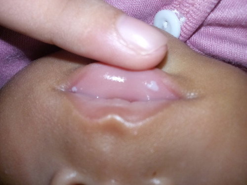 Bercak putih di bibir bayi