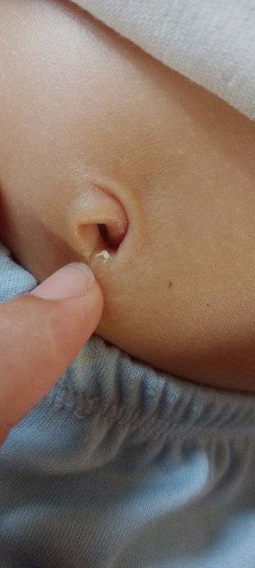 Ada putih seperti susu dipusat bayi