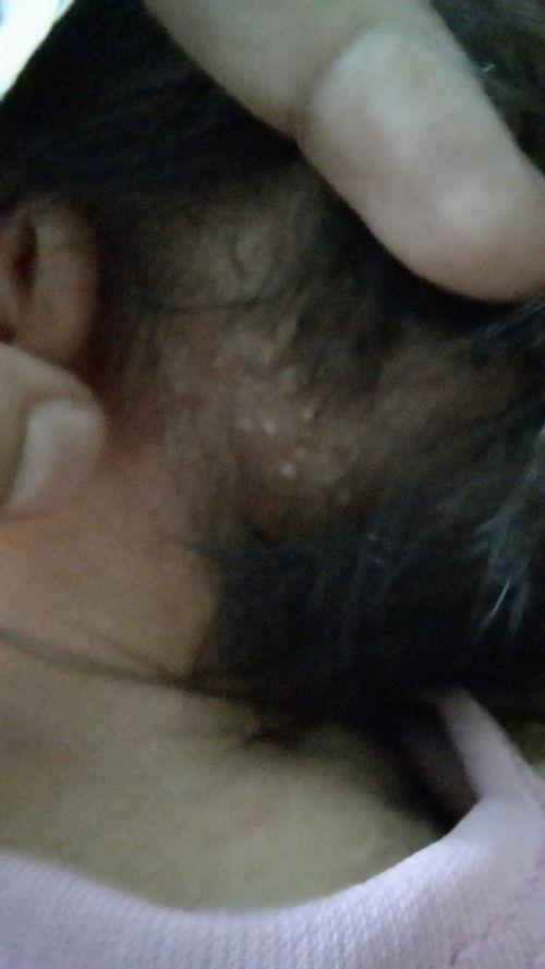 Bruntusan biang keringat