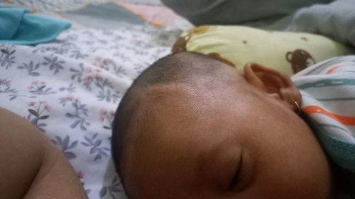 bun mau tanya ini normal ga yaa di kepala anak ku ada garis gini sedikit menonjol? anak ku baru 1,5