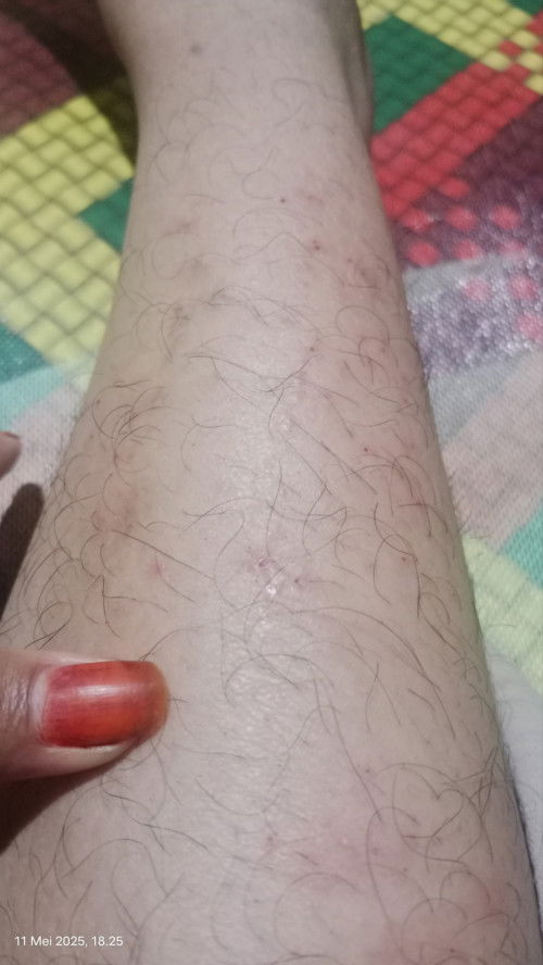 Gatal pada badan