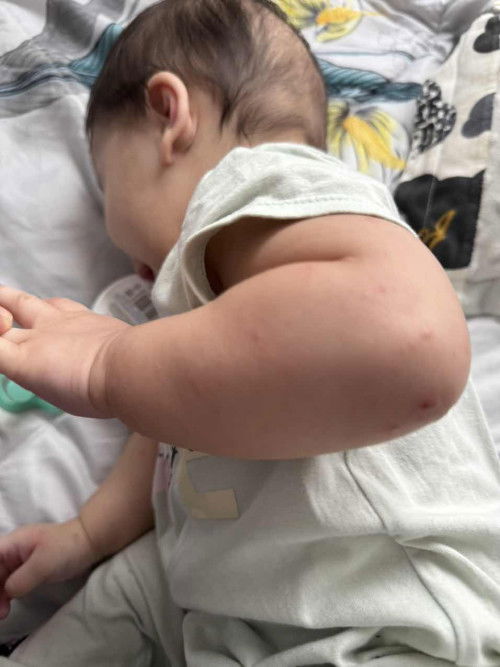 Baby saya 8 bulan demam 38c, masuk ubat bontot. Esoknya naik rashes