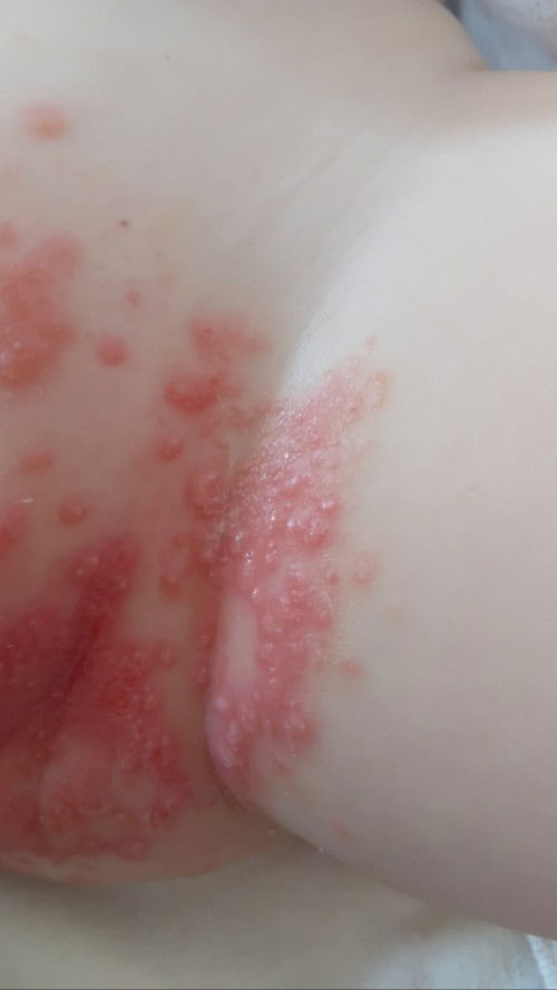 Bun,numpang tnya cream apa yg bagus untuk Selangkangan bayi kemerahan smpai berair