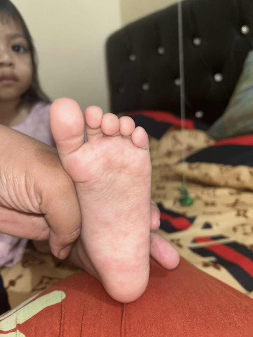 Gatal dan kemerahan saat malam hari jadi lebih rewel