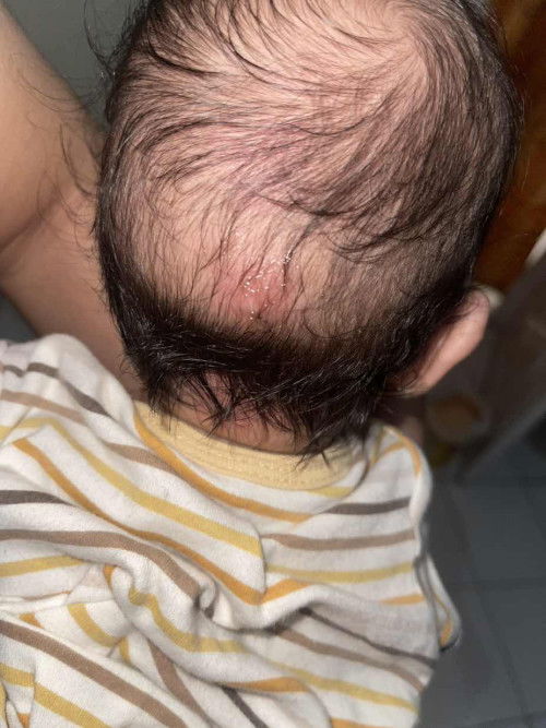 Udunen / bisul di kepala bayi