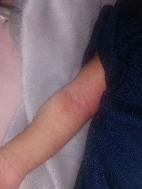 bintik bintik kecil pada bayi