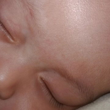 Bun.muka anak aku sprti putih2 gtu obat nya apa.ya.? Sudah dksih bemee sma lctacyd baby tp blm smbuh