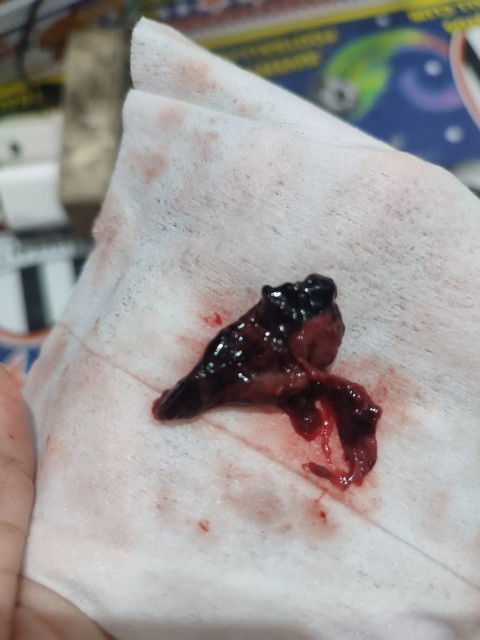 Ini apa ya Bun udh keluar 3x ini ukuran ny aga lbih kecil dari sebelumnya,tespek garis 2 tpi 1 samar