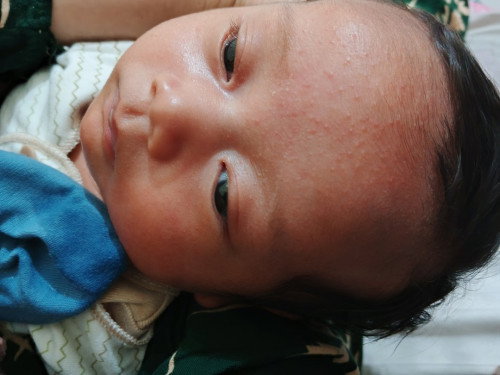 ruam kulit bayi