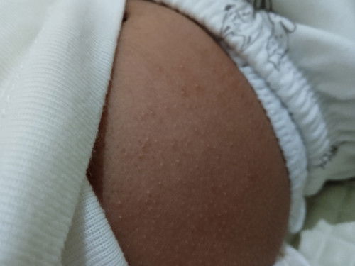 Bun, perut babyku muncul bintik² kemerahan tp hanya diperut aja kira² obatnya apa ya ???