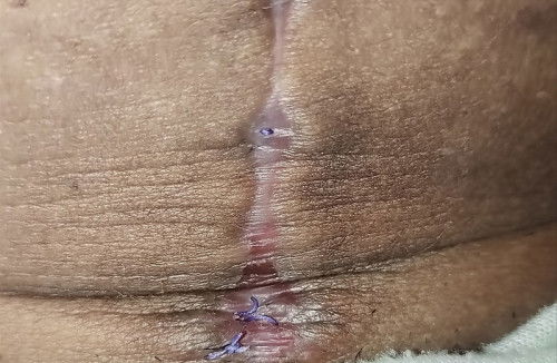 Normal ba Ang ganitong tahi Ng cesarean na may lumalabas na sinulid bukod sa sobra?Mag 1month nasa17