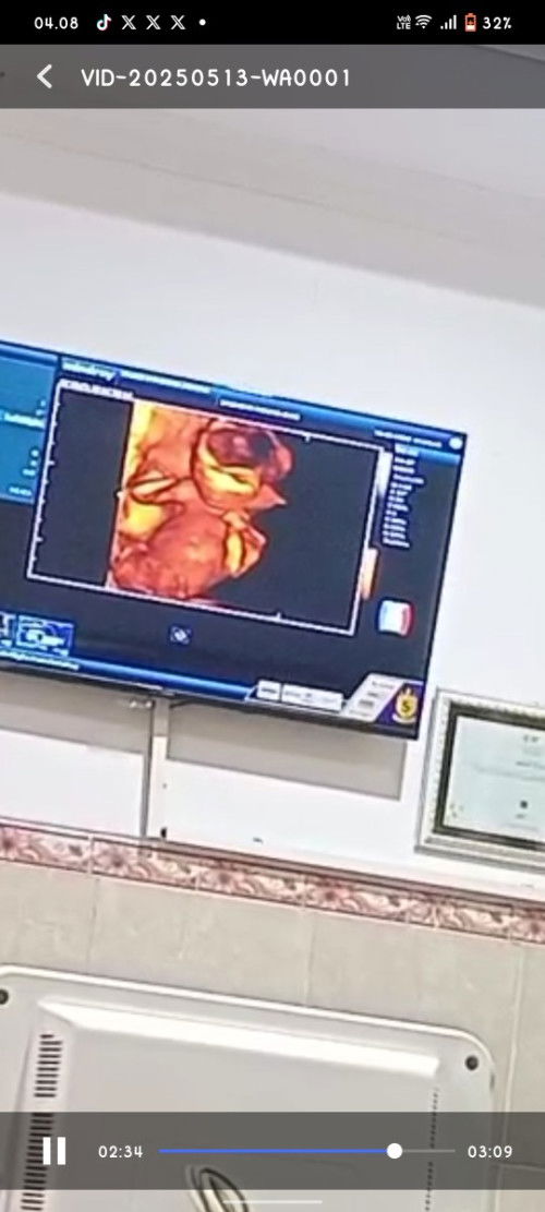 Hallo moms,ada yang sudah USG terus sudah kelihatan jari tangan dan kaki nya belum nya ,kemarin USG