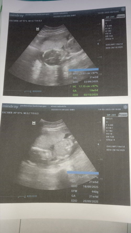 Hamil 16 w tapi baby seperti 21 w