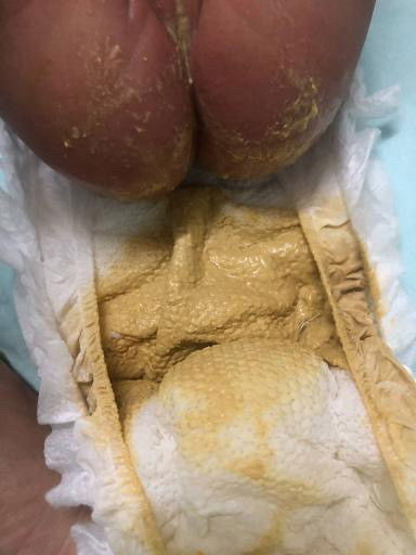 สอบถามแม่ๆว่าอึสีแบบนี้ปกติมั้ยคะ