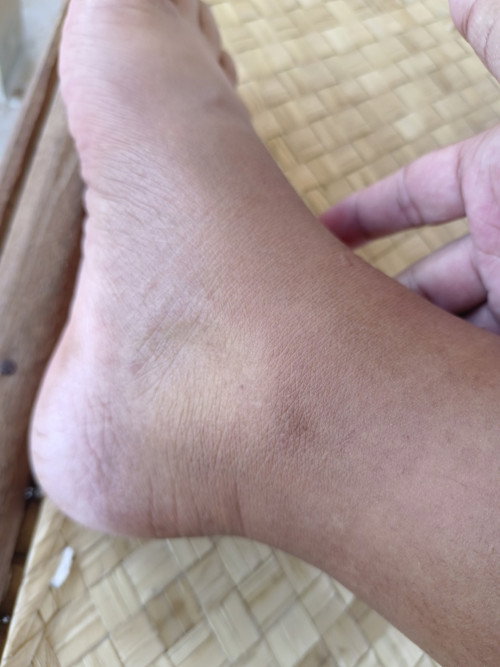 สอบถามแม่ๆเรื่องเท้าบวมคะ