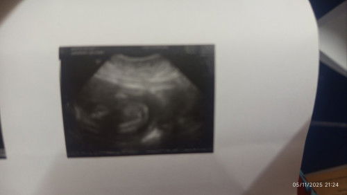 Ni baby boy or girl??? sekarang 33 weeks 2.4kg berat bayi kepala masih ke atas ???