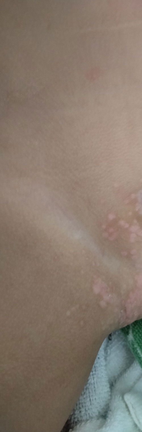 Ada yg pernah ngalamin ruam popok begini anaknya bun? Dipakein apa ya biar cpt sembuh