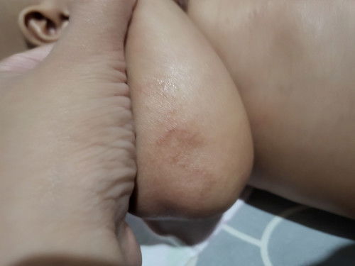Kulit kering