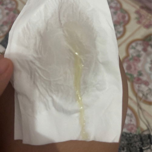 มีมูกออกแบบนี้ปกติมั้ยคะ พอดีคุณหมอพึ่งกระตุ้นคลอดให้วันนี้ค่ะ