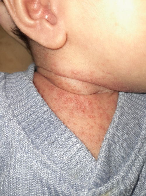 Merah dan bintik ber air pada bayi