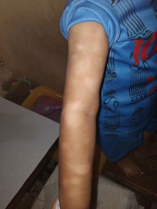 Gangguan kulit pada anak