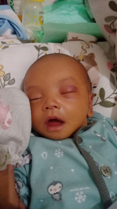 Mata belekan dan bengkak sebelah