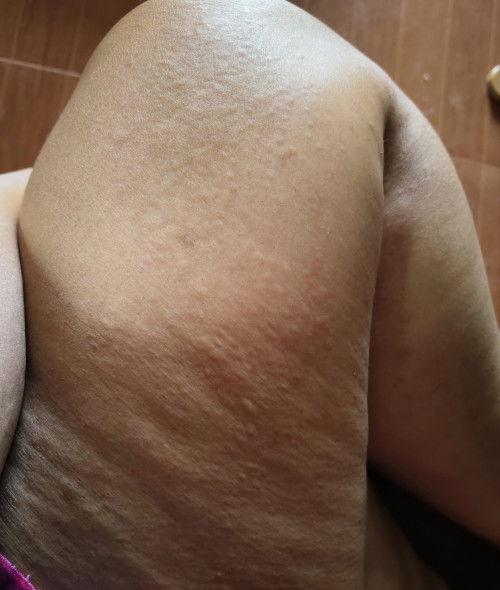 อาการคันตามร่างกาย