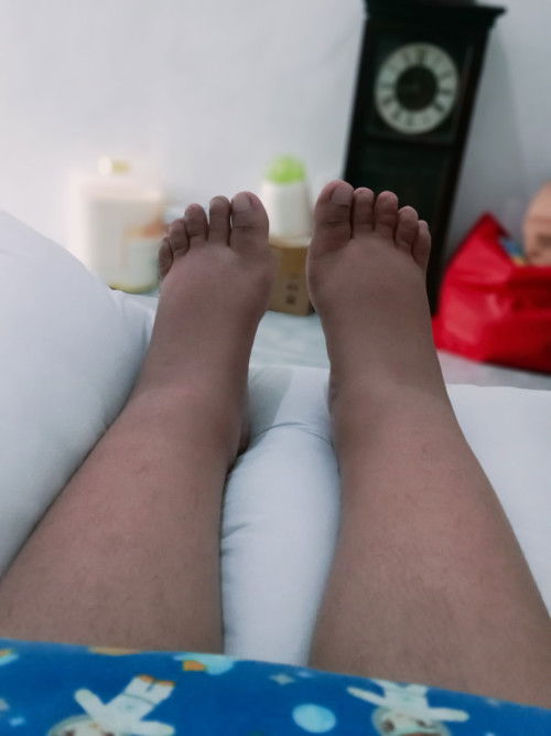 Kaki dan Tangan Bengkak di TM 3