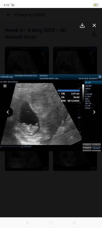 klu scan mcm ni normal ke