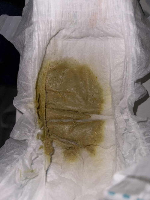 Breastfeeding poop